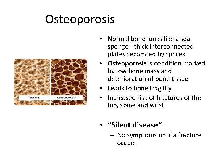 Osteoporosis • Normal bone looks like a sea sponge - thick interconnected plates separated