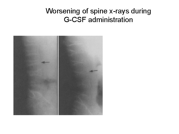 Worsening of spine x-rays during G-CSF administration 