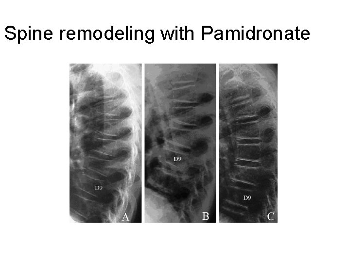 Spine remodeling with Pamidronate 