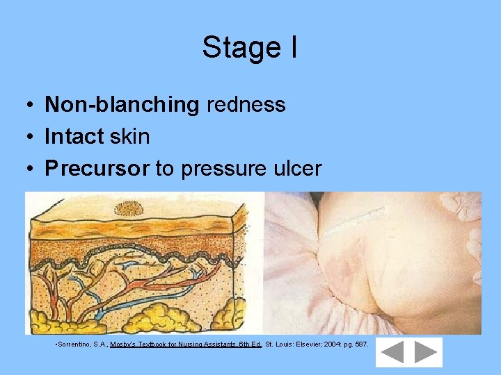 Stage I • Non-blanching redness • Intact skin • Precursor to pressure ulcer •