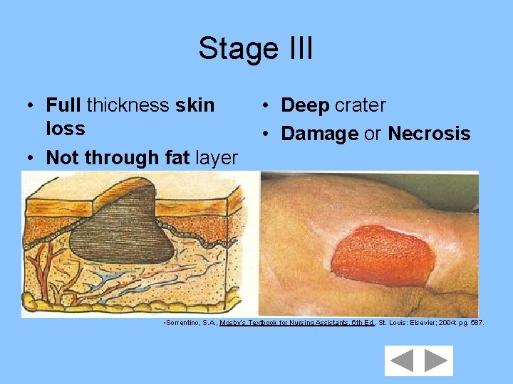 Stage III • Full thickness skin loss • Not through fat layer • Deep