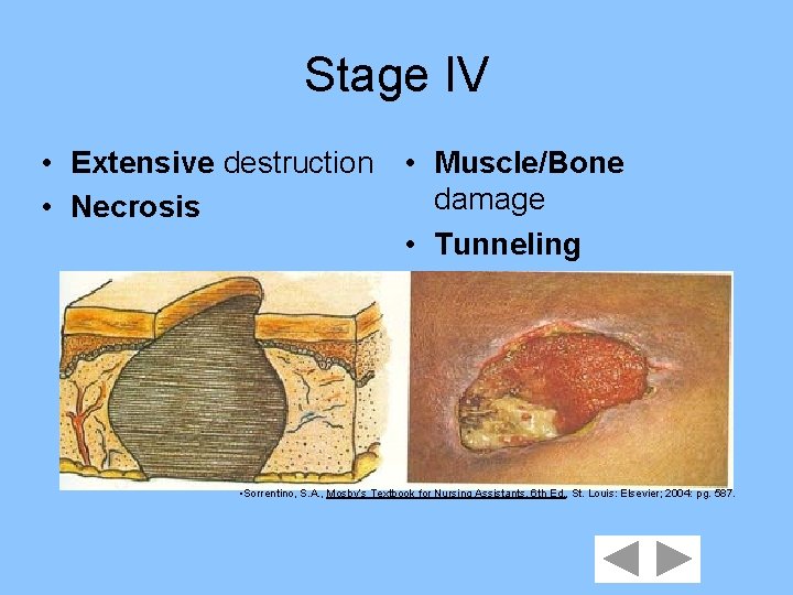 Stage IV • Extensive destruction • Muscle/Bone damage • Necrosis • Tunneling • Sorrentino,