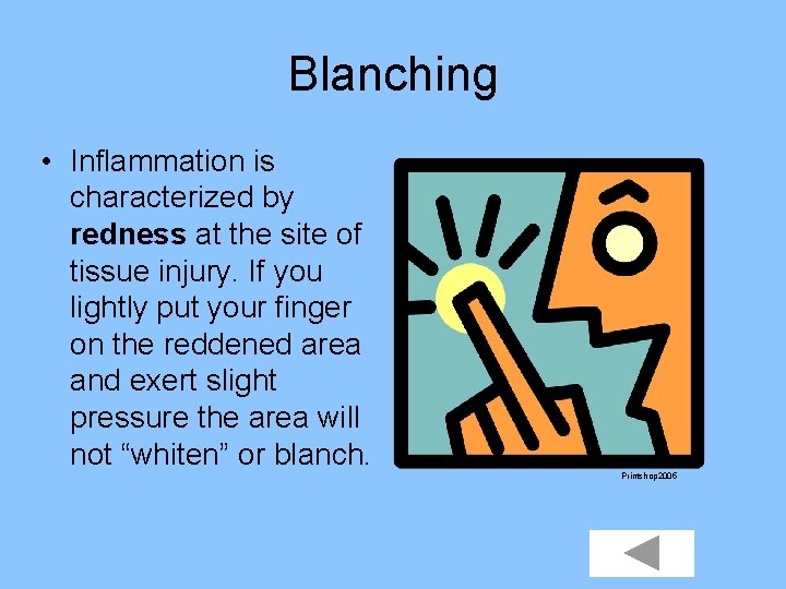 Blanching • Inflammation is characterized by redness at the site of tissue injury. If