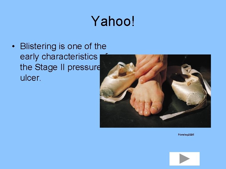 Yahoo! • Blistering is one of the early characteristics of the Stage II pressure