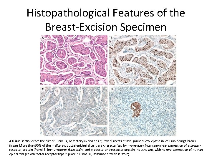 Histopathological Features of the Breast-Excision Specimen A tissue section from the tumor (Panel A,