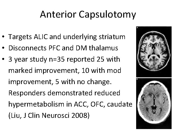 Anterior Capsulotomy • Targets ALIC and underlying striatum • Disconnects PFC and DM thalamus