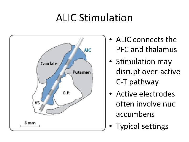 ALIC Stimulation • ALIC connects the PFC and thalamus • Stimulation may disrupt over-active