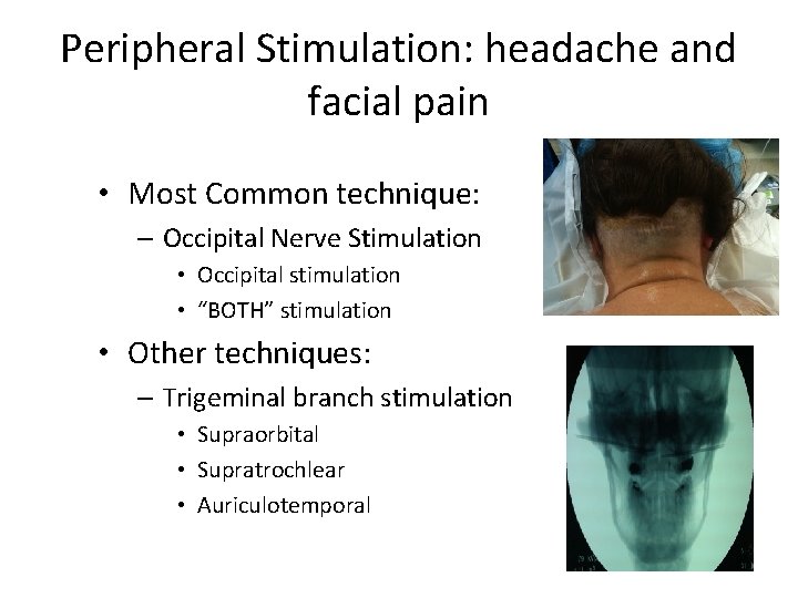 Peripheral Stimulation: headache and facial pain • Most Common technique: – Occipital Nerve Stimulation