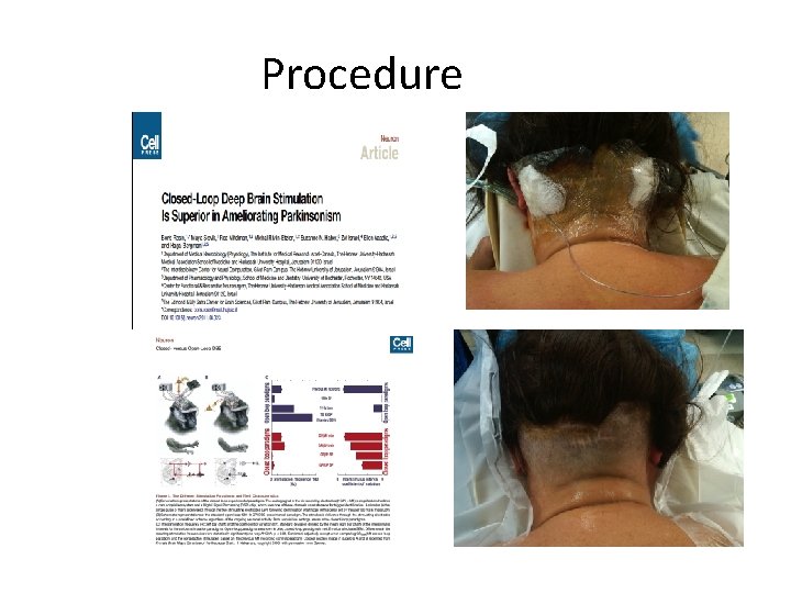 Procedure 