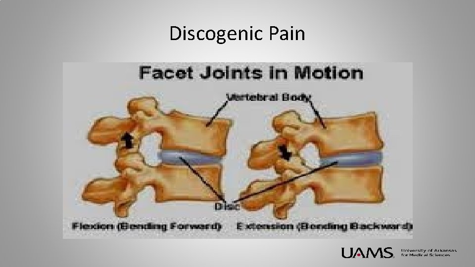 Discogenic Pain 