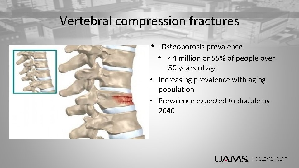 Vertebral compression fractures • Osteoporosis prevalence • 44 million or 55% of people over