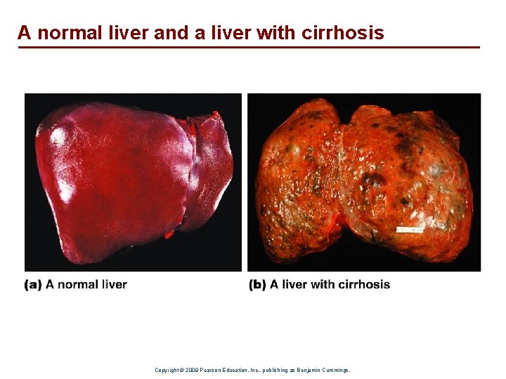 A normal liver and a liver with cirrhosis Copyright © 2009 Pearson Education, Inc.
