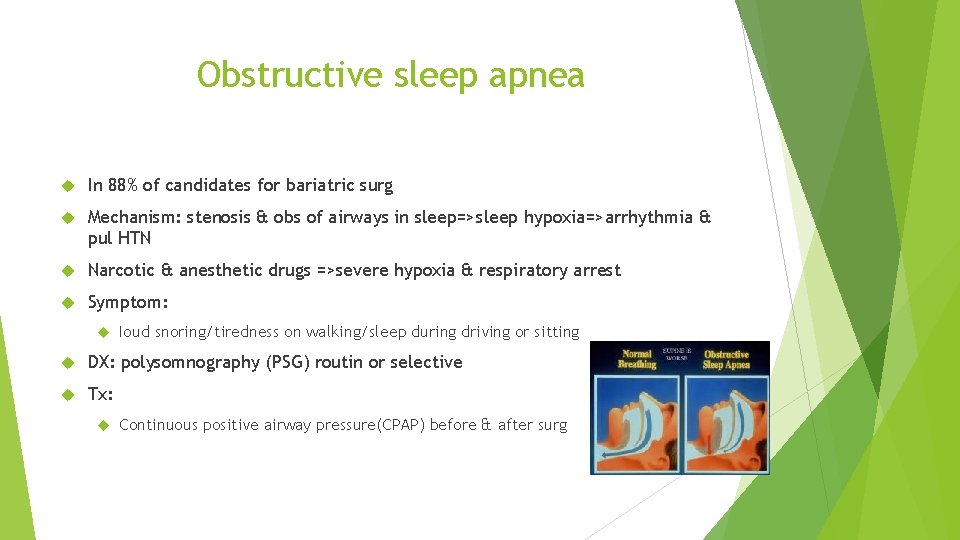 Obstructive sleep apnea In 88% of candidates for bariatric surg Mechanism: stenosis & obs