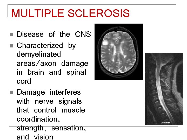 MULTIPLE SCLEROSIS n n n Disease of the CNS Characterized by demyelinated areas/axon damage