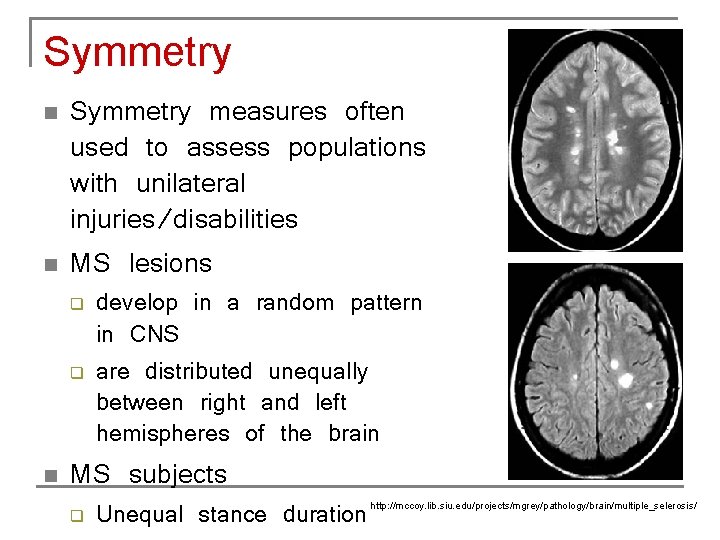 Symmetry n n Symmetry measures often used to assess populations with unilateral injuries/disabilities MS