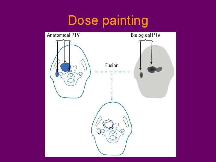 Dose painting 