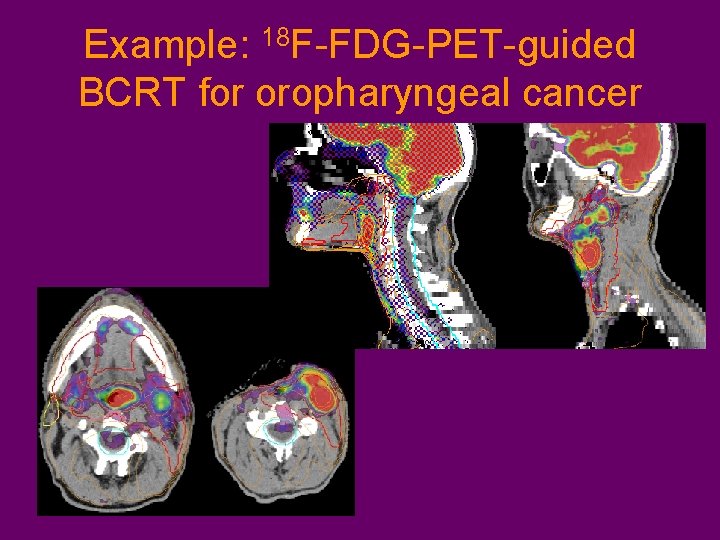 Example: 18 F-FDG-PET-guided BCRT for oropharyngeal cancer 