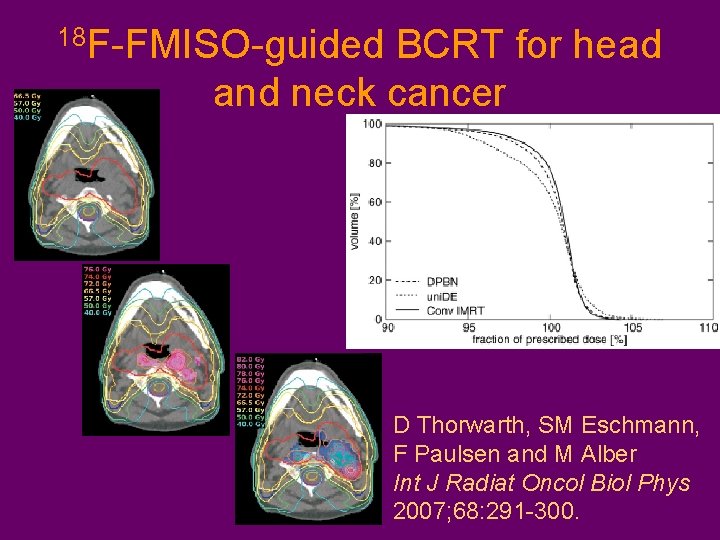 18 F-FMISO-guided BCRT for head and neck cancer D Thorwarth, SM Eschmann, F Paulsen