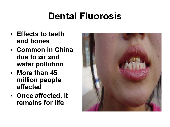 Dental Fluorosis • Effects to teeth and bones • Common in China due to