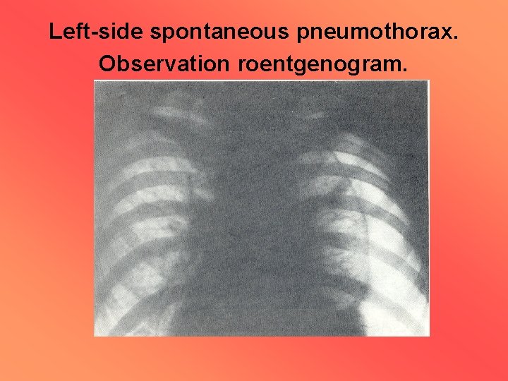 Left-side spontaneous pneumothorax. Observation roentgenogram. 