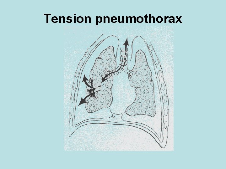 Tension pneumothorax 