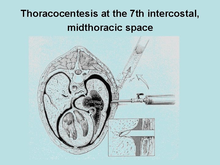 Thoracocentesis at the 7 th intercostal, midthoracic space 