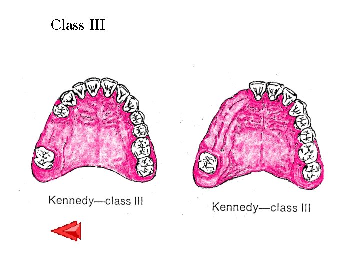 Class III 