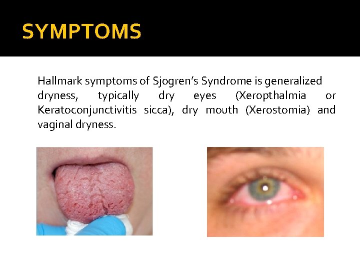 SYMPTOMS Hallmark symptoms of Sjogren’s Syndrome is generalized dryness, typically dry eyes (Xeropthalmia or