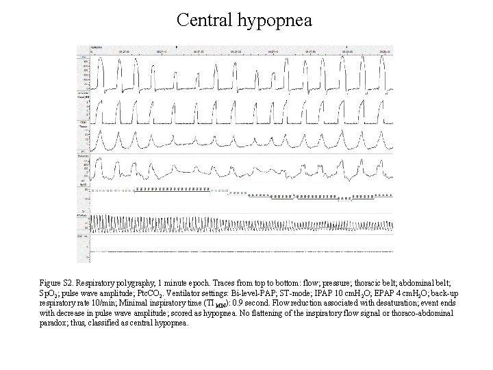 Central hypopnea Figure S 2. Respiratory polygraphy, 1 minute epoch. Traces from top to