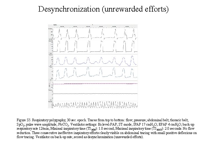 Desynchronization (unrewarded efforts) Figure S 5. Respiratory polygraphy, 30 sec. epoch. Traces from top