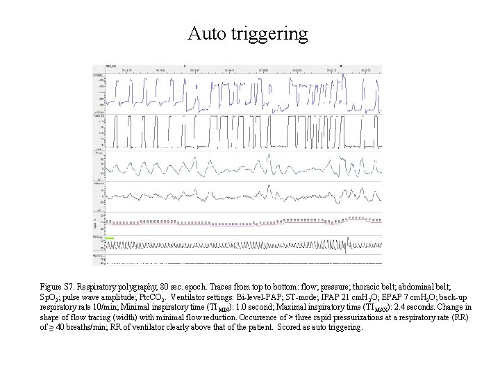 Auto triggering Figure S 7. Respiratory polygraphy, 80 sec. epoch. Traces from top to