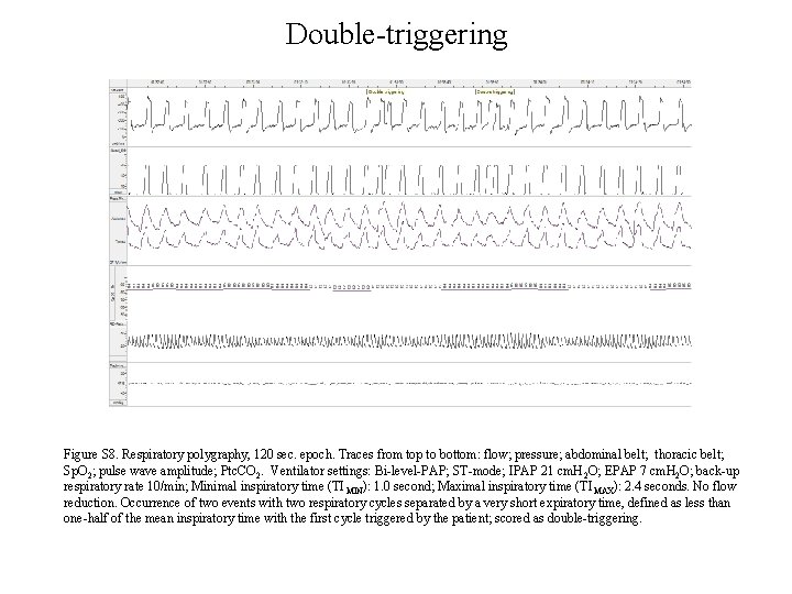 Double-triggering Figure S 8. Respiratory polygraphy, 120 sec. epoch. Traces from top to bottom: