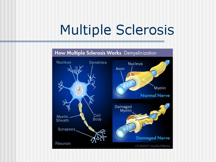 Multiple Sclerosis 