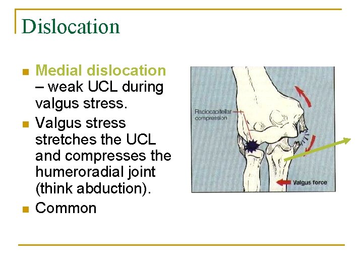 Dislocation n Medial dislocation – weak UCL during valgus stress. Valgus stress stretches the