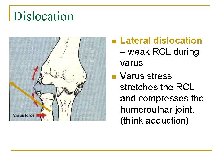 Dislocation n n Lateral dislocation – weak RCL during varus Varus stress stretches the