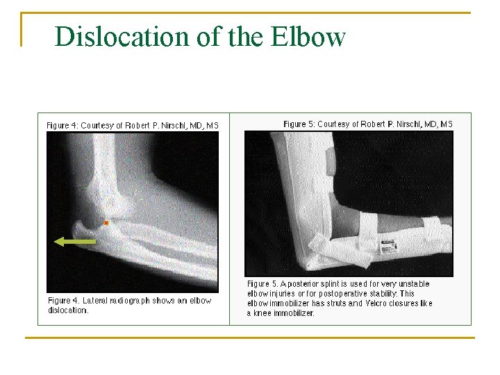 Dislocation of the Elbow 