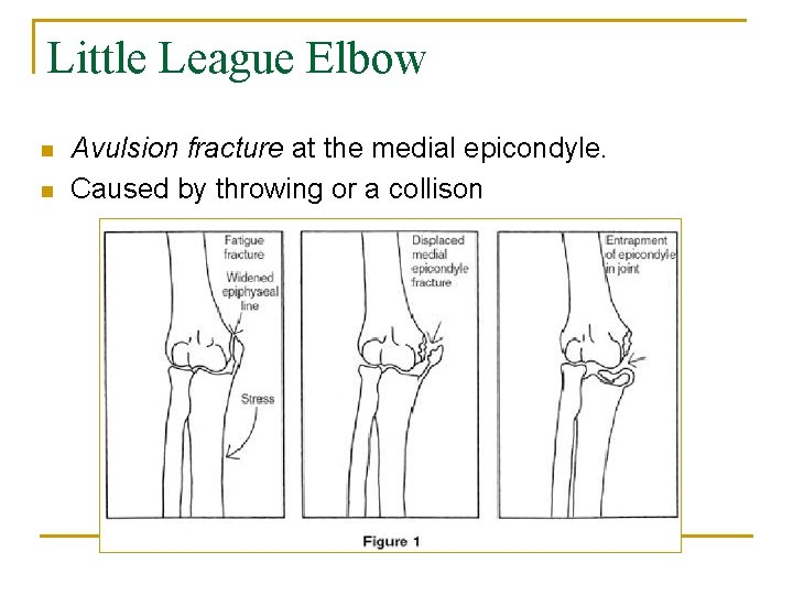 Little League Elbow n n Avulsion fracture at the medial epicondyle. Caused by throwing