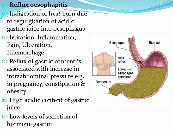  Reflux oesophagitis Indigestion or heat burn due to regurgitation of acidic gastric juice