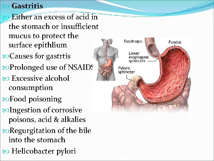  Gastritis Either an excess of acid in the stomach or insufficient mucus to