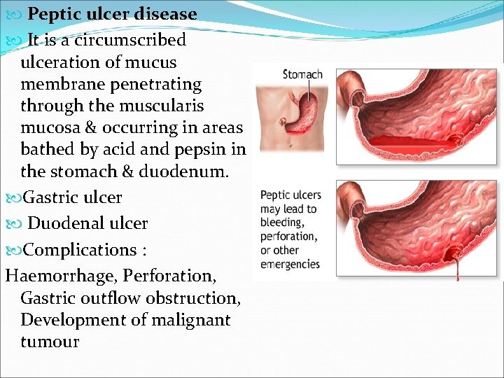  Peptic ulcer disease It is a circumscribed ulceration of mucus membrane penetrating through