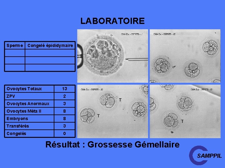 LABORATOIRE Sperme Congelé épididymaire Ovocytes Totaux 13 ZPV 2 Ovocytes Anormaux 3 Ovocytes Méta