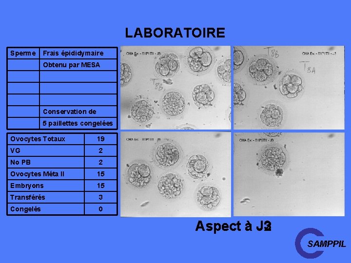 LABORATOIRE Sperme Frais épididymaire Obtenu par MESA Conservation de 5 paillettes congelées Ovocytes Totaux