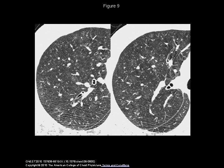 Figure 9 CHEST 2010 137938 -951 DOI: (10. 1378/chest. 09 -0800) Copyright © 2010