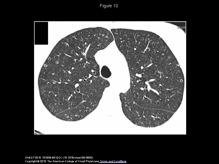 Figure 10 CHEST 2010 137938 -951 DOI: (10. 1378/chest. 09 -0800) Copyright © 2010