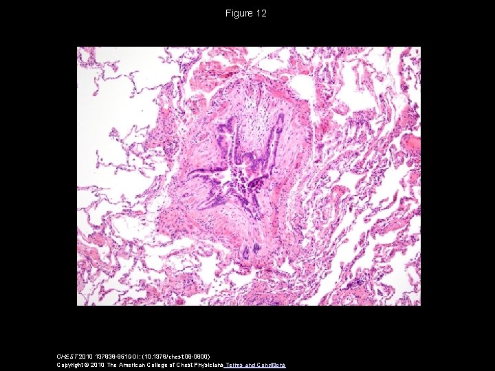 Figure 12 CHEST 2010 137938 -951 DOI: (10. 1378/chest. 09 -0800) Copyright © 2010