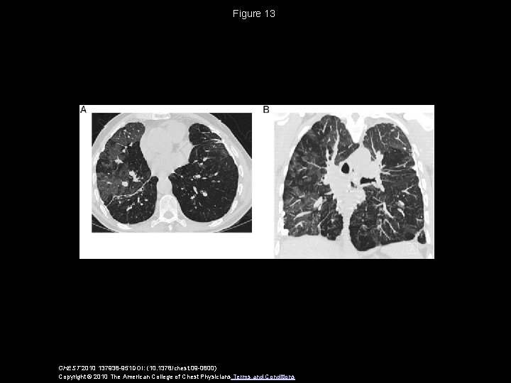 Figure 13 CHEST 2010 137938 -951 DOI: (10. 1378/chest. 09 -0800) Copyright © 2010