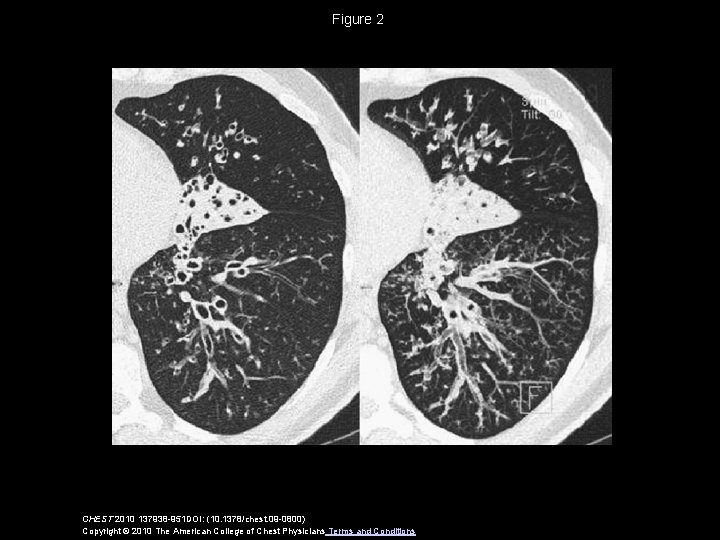 Figure 2 CHEST 2010 137938 -951 DOI: (10. 1378/chest. 09 -0800) Copyright © 2010