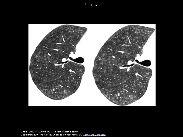 Figure 4 CHEST 2010 137938 -951 DOI: (10. 1378/chest. 09 -0800) Copyright © 2010