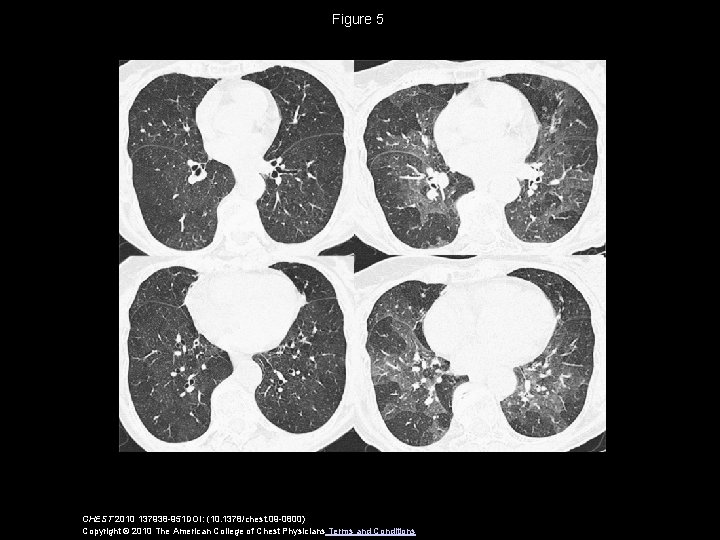 Figure 5 CHEST 2010 137938 -951 DOI: (10. 1378/chest. 09 -0800) Copyright © 2010