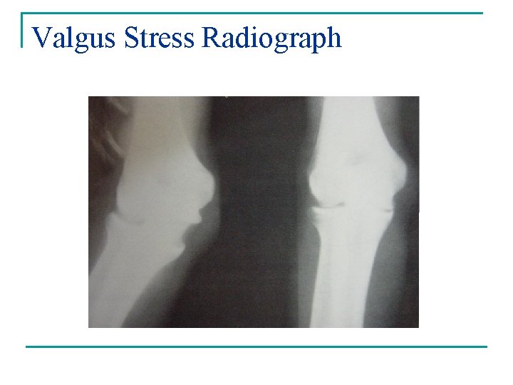 Valgus Stress Radiograph 